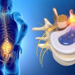 can-i-train-with-a-herniated-disc?