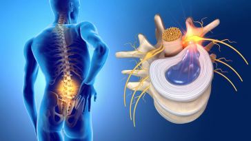 can-i-train-with-a-herniated-disc?