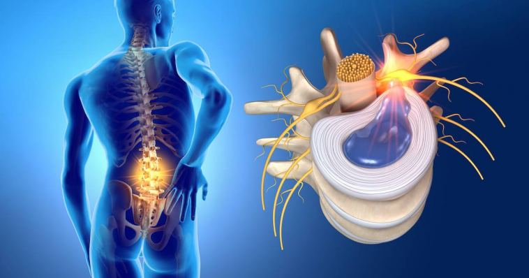 can-i-train-with-a-herniated-disc?