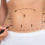tummy tuck