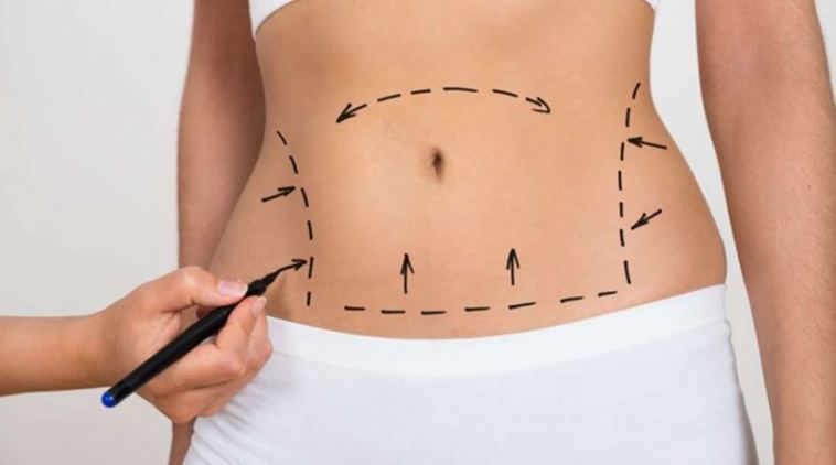 tummy tuck