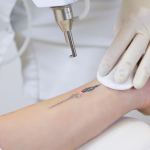 laser tattoo removal