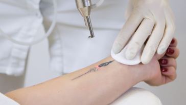 laser tattoo removal