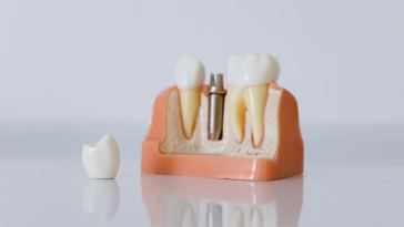 dental implant
